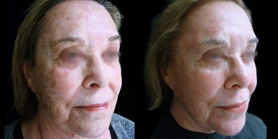 65-74 year old woman treated with ActiveFX - This patient underwent TotalFX laser resurfacing. The DeepFX laser handpiece was used to treat around the eyes and around the mouth. The ActiveFX laser handpiece was used to treat the entire face.