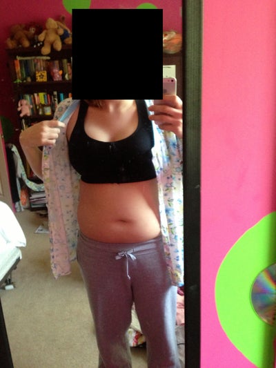 25 Years Old 3 Kids 36F Breast Reduction - Review - RealSelf