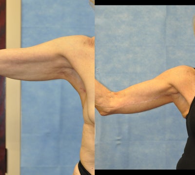 70 Year Old Female - 
	70 Year Old Female Diagnosis: Dermatochalasis of Upper Arms Procedure: Bilateral Brachioplasty
