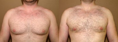 Gynecomastia correction  (male breast correction) - 
	Gynecomastia correction with liposuction and direct excision of the mammary gland - no skin excision and scars
