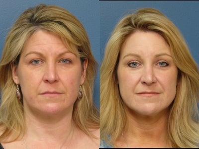 Brow Lift - 35-44 year old woman treated with Brow Lift