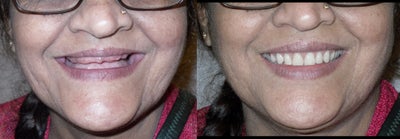 Implant Dentistry - 
	A 60 yrs old patient was treated with implant supported overdentures. Patient came to us with few remaining mobile teeth and gum problems. Her badly carious and mobile teeth were extracted/removed and implants were placed in both the jaws, over which implant supported dentures were placed.
