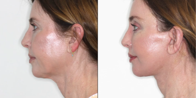 Woman treated with Neck Lift, Facelift - Deep Plane Face and Neck lifts have become the procedure for facial rejuvenation.I have performed this surgery for over 12 years and understand the nuances.This shows the Left Lateral Before / After fade at only 2 weeks post Deep Plane Face and Neck Lift and Browlift.My patient had noticed early signs of aging including loose skin on the jawline (jowls) and loose skin and soft tissue in the neck as well as heaviness of the brows and upper eyelids.She wanted to deal with these issues before they became more obvious.Now at 2 only weeks postop:Note the improvement of the jawline and neck contour. There is no redundant neck tissue. Also, note the refreshed appearance of the eyes and forehead.Those in the know understand that Deep Plane Face and Neck lifts take the tension off the skin so there is no pulled look. Deep Plane Face and Neck lifts are natural-looking because the patient's own ligaments are re-tensioned and repositioned. A deep plane is ideal for younger or older patients.