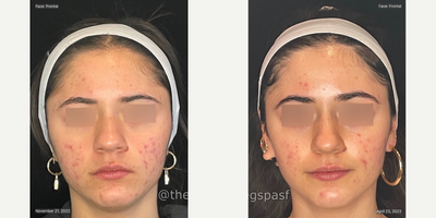 18-24 year old woman treated with AviClear - 3 Month progress photos after 3 sessions of AviClear