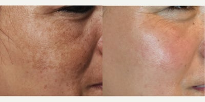 Melasma Before and After photos Los Angeles - Patient has profound Melasma that we treated with our proprietary hydroquinone product.  The high strength prescription gel pads work better than most HQ formulations because of their higher than average % of hydroquinone combined with the fact that the gel solution sinks into the skin easily.  This is after 3 months using the product.