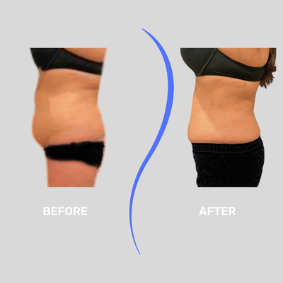 35-44 year old woman treated with Funsculpting HD Lipo - 35-44 year old woman treated with Funsculpting HD Lipo of the belly. 90 day results, patient down 3 inches from 1 session. Procedure completed by Paul West PA-C.
