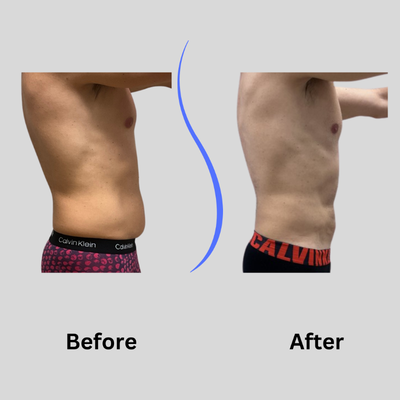 35-44 year old man treated with Funsculpting HD Lipo - 45-54 year old male treated abs+flanks with 1 session Funsculpting HD Lipo at the Brookfield location with Paul West PA-C. Patient down 2.5 in 60 days.