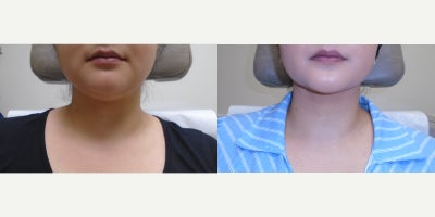 18-24 year old woman treated with Smart Lipo - 18-24 year old woman treated with Chin Smart Lipo