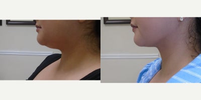 18-24 year old woman treated with Smart Lipo - 18-24 year old woman treated with Chin Smart Lipo