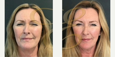 Woman treated with Dysport - Woman treated with Dysport