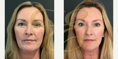 Woman treated with Dysport - Woman treated with Dysport