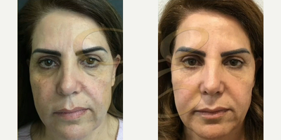 Woman treated with Laser Resurfacing - Woman treated with Laser Resurfacing