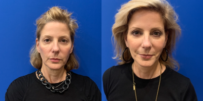 55-64 year old woman treated with MACS Facelift - 58 year old female before and 6 months after my favorite type of mini facelift, MACS Facelift addressing mid-face, jowls and neck.