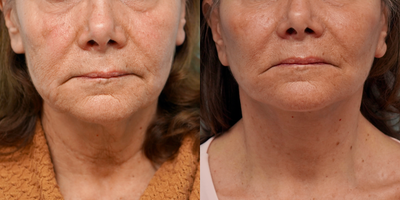 55-64 year old woman treated with Facelift - Face and neck lift with facial lipofilling