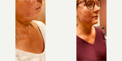 Woman treated with Nonsurgical Facelift - Evoke after 2 treatments