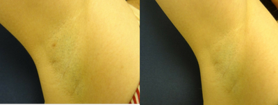 18-24 year old woman treated with Laser Hair Removal - 23 year old before and after 4 laser hair removal treatments to the armpits. Notice the dramatic improvement and over 95% reduction of hair follicles. This is a dramatic result. We have the latest laser hair removal technology that is virtually painless, fires 30 pulses per second and is the most effective technology available on the market today.