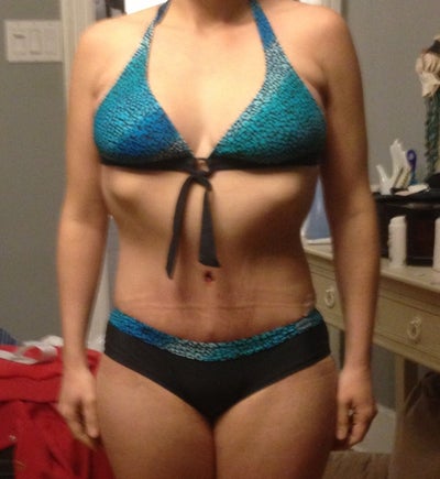Tummy Tuck after Weight Loss - Halifax, NS