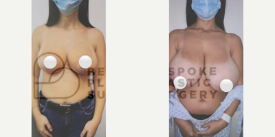 Breast Reduction - Woman treated with Breast Reduction