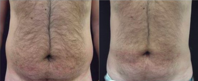 35-44 year old man treated with UltraShape - Patient did three treatments 2 weeks apart.