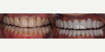 55-64 year old woman treated with Porcelain Veneers, Smile Makeover - Full mouth rehabilitation. This 60-year-old female patient presented with multiple old bridges, many missing upper teeth, over-prepped teeth, and decay. Aesthetically she wanted a much cleaner brighter and youthful look. This was a combination of 24 porcelain restorations including crowns veneers and bridges. She required gum procedures (crown lengthening) as well, especially the front lateral. This was for stability, not aesthetics, and not in her smile line (her lip covers it when she smiles) The purpose of this was health function and aestheticsand she looks a decade younger.