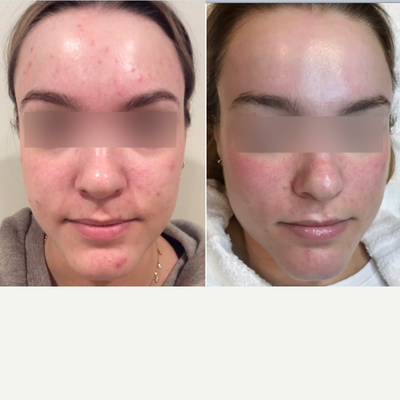 18-24 year old woman treated with Vi Peel - Post 2 Vi Precision Plus Peels