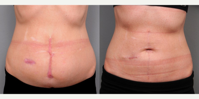 Abdominal Scar Revision & Belly Button Reconstruction - This 29-year-old woman came in asking for revision of her abdominal scar. She also noted that she could not locate her belly button since her previous emergency surgery. Her before-and-after photos are shown to the left (after photos taken 6 weeks later). Note the umbilicus has been reconstructed in addition to the scar revision. Dr. Sterry takes a custom approach to create discreet scars for all patients.