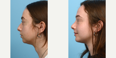 18-24 year old man treated with Chin Surgery - This patient underwent a combination rhinoplasty and chin augmentation surgery to improve her facial symmetry. 8 weeks post-op, she's thrilled with the outcome.