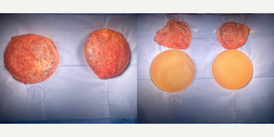 45-54 year old woman treated with Capsular Contracture Treatment, Breast Implant Removal - Female patient with breast implant illnes (BII) and Asia syndrome, she had an Enbloc capsulectomy after breast augmentation surgery. She underwent for a total Capsulectomy surgery with an Enbloc surgery technique. You can see the total capsule removal with her implants inside the capsule, and the capsule thickness. After her surgery all her symptoms disappeared.