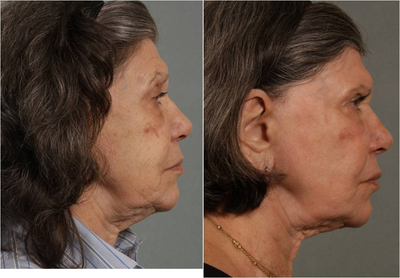 77 Year Old Female Treated for Wrinkles, Age Spots, and Skin Laxity non surgically - 
	Before: deflation of face with sagging skin in 77 year old patient who doesnt want surgical intervention. Also has age spots and deep wrinkles. After: Fraxel Re:pair laser was used to treat her deep wrinkles and tighten her skin along her jaw line and neck. Fraxel Dual 1927 two treatments to further improve her skin tone and texture. Volume restoration in her face and jaw line has had an uplifting effect. In addition, 4 Sculptra treatments were used. Results need to be touched up every two years.

