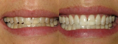 KOR Whitening - 	KOR Whitening- Deep Bleaching System. Patient did in office treatments as well as bleaching with KOR trays at home.