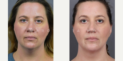 Woman treated with Renuvion - Submental Liposuction with Renuvion. Witness the stunning before-and-after photos of our satisfied patient!Our patient underwent submental liposuction, a minimally invasive procedure targeting excess fat beneath the chin. But thats not all, we took it a step further with Renuvion, a cutting-edge technology for skin tightening.Whats submental liposuction? This procedure precisely targets and removes stubborn fat, revealing a more defined and contoured neck and jawline.Whats Renuvion skin tightening? Using a unique combination of helium plasma and radiofrequency energy, Renuvion tightens and rejuvenates the skin, ensuring a smoother and more youthful appearance.