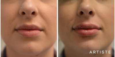 28 year old woman treated with Lip Fillers - 28 year old woman treated with Lip Fillers.