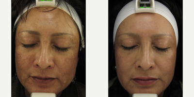 35-44 year old woman treated with Clear and Brilliant - Clear and brilliant