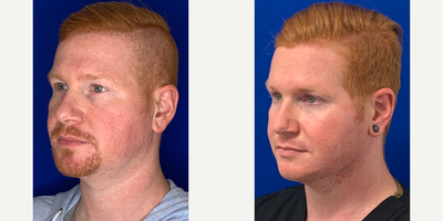 25-34 year old man treated with Chin Liposuction - 3 weeks after submental liposuction