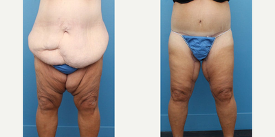 Woman treated with Body Lift - Woman treated with Body Lift | Thigh Lift