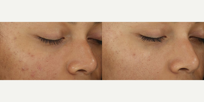 Woman treated with DiamondGlow - Woman treated with DiamondGlow