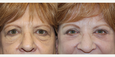65-74 year old woman treated with Eyelid Surgery - 65 year old female undergoing upper and lower eyelift surgery.