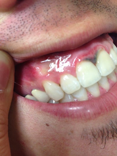 grey-and-black-gums-after-professional-teeth-whitening-photo-doctor