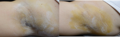 36 year old woman treated with miraDry - This patient was treated with miraDry, a non-surgical treatment that eliminates sweat glands from the underarm region by using microwave technology. The results are immediate and permanent. The photos show the starch test, the black regions indicating sweat. You can see the the sweat production is dramatically decreased in her before and after photos.