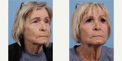 65-74 year old woman treated with Obagi Nu-Derm - 65-74 year old woman treated with Obagi Nu-Derm