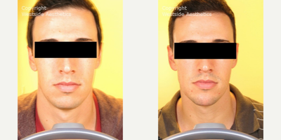 Non Surgical Chin Enhancement on Young Man - The male patients weakened chin caused his overall appearance to look round, undefined, and immature. Dr. Rivkin administered Radiesse, a temporary filler most commonly used to add structure to areas that are otherwise lacking, to provide the patient with a more pronounced chin and a more chiseled appearance.