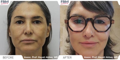 55-64 year old woman treated with Facelift, Facial Fat Transfer, Deep Plane Facelift, Lip Lift, Neck Lift, Eyelid Surgery - 55-64 year old woman treated with Facelift, Facial Fat Transfer, Deep Plane Facelift, Lip Lift, Neck Lift, Eyelid Surgery