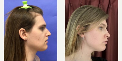 Patient treated with Forehead Reduction, Brow Lift, Septoplasty, Adam's Apple Reduction, Facial Fat Transfer - 25 to 34 year-old female patient is 1 year post-op from Facial Feminization surgery. Her procedures included:Forehead Lift, Hairline Lowering, Superorbital Bone Reduction and ContouringSeptorhinoplasty (closed) with Cartilage Grafts and WeirsChin Reduction and ContourThyroid Cartilage ShaveVoice FeminizationFat Augmentation to Lips