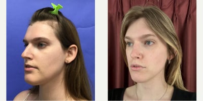 Patient treated with Forehead Reduction, Brow Lift, Septoplasty, Adam's Apple Reduction, Facial Fat Transfer - 25 to 34 year-old female patient is 1 year post-op from Facial Feminization surgery. Her procedures included:Forehead Lift, Hairline Lowering, Superorbital Bone Reduction and ContouringSeptorhinoplasty (closed) with Cartilage Grafts and WeirsChin Reduction and ContourThyroid Cartilage ShaveVoice FeminizationFat Augmentation to Lips