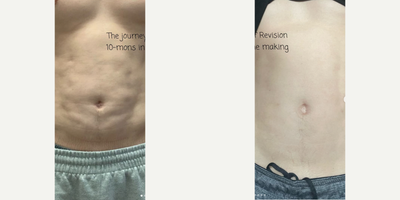 Man treated with Liposuction Revision - Man treated with Liposuction Revision