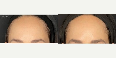 Skincare Routine - Before and After showing the effects of a proper skincare routine on a patient's skin