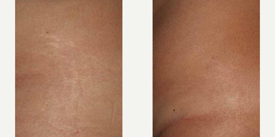 Woman treated with ResurFX - Photo provided courtesy of Lumenis, Ltd., performed by Matteo Tretti Clementoni, MD