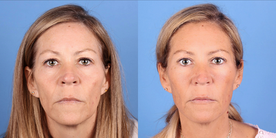 45-54 year old woman treated with Dermal Fillers, Voluma, Vollure, Juvederm, Lip Fillers - vollux to jawlinevollure under eye hollowsvoluma cheeksjuvederm ultra lips