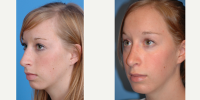 18-24 year old woman treated with Chin Implant - Rhinoplasty and chin implant