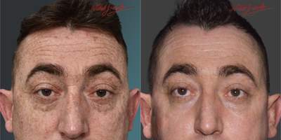 45-54 Years Old Man Treated with PicoSure - As a result of Pico Laser treatment; the final state of our patient; whose freckles were removed.